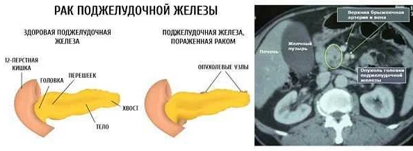 Как умер джозеф джексон (отец майкла джексона)