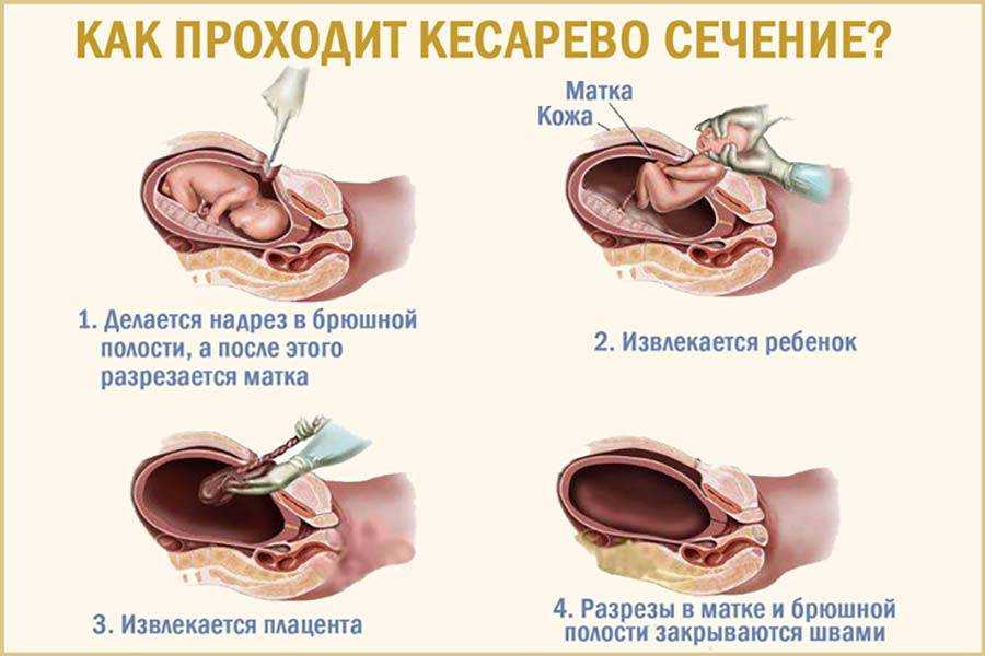 Роды после кесарева сечения. мой опыт. - рассказы о родах - страна мам