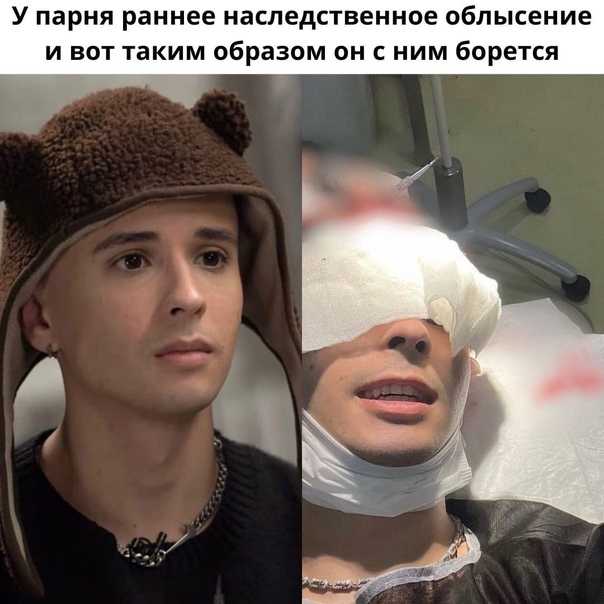 Слава марлоу пересадка волос