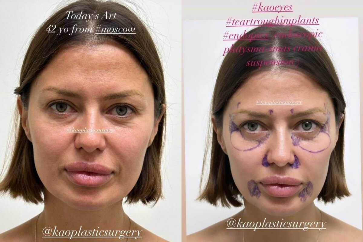 Виктория боня до и после пластики